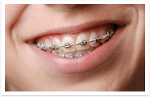 Braces Brackets